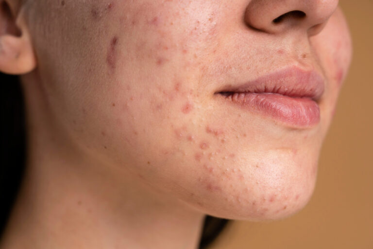 9 Foods that Cleared My Stubborn Chin Acne for Good (Hormonal Acne Diet)